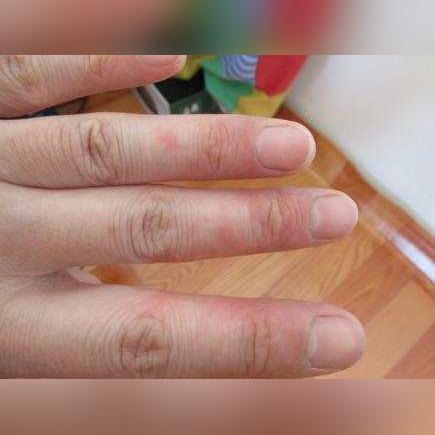 脚上起小水泡还很痒?别忽视,这可能是身体在发出警报 脚上起小水泡还很痒?别忽视,这可能是身体在发出警报